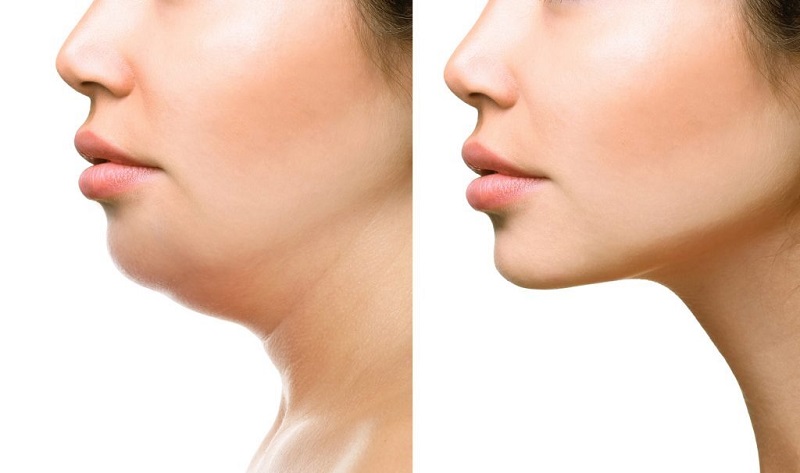 Gương mặt trở nên thon gọn, dáng cổ trông cao hơn ban đầu sau khi cấy hủy mỡ nọng cằm