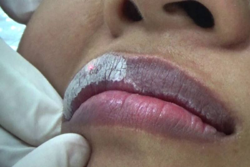 Môi nứt nẻ và thâm đen vì không dưỡng ẩm tốt
