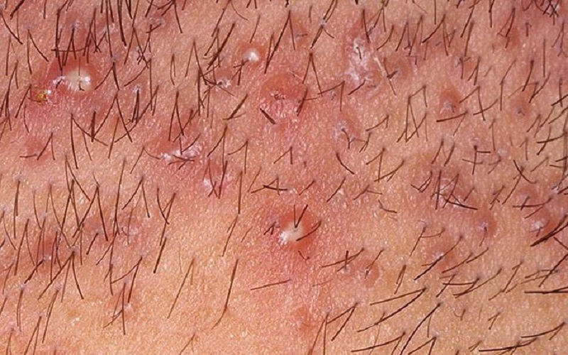 Vùng nách bị viêm nang lông gây đau, khó chịu