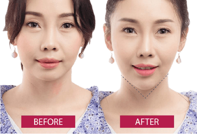 Dáng cằm của khách hàng trước và sau khi tiêm Filler