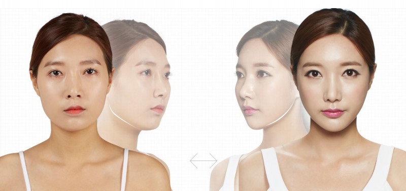 Tiêm Filler cằm mang lại nhiều ưu điểm vượt trội