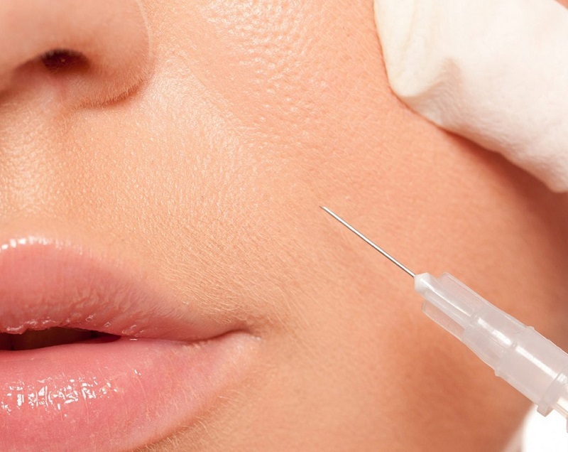 Tiêm Filler rãnh cười trở thành dịch vụ thẩm mỹ không phẫu thuật được nhiều người ưa chuộng