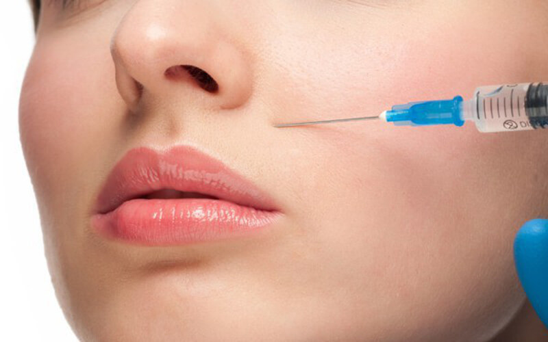 Tiêm Filler vào vùng rãnh cười giúp san phẳng rãnh cười, giảm nếp nhăn