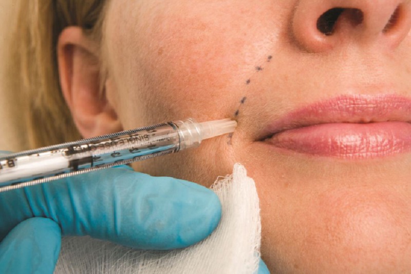 Quá trình tiêm Filler rãnh cười bác sĩ chỉ dùng kim chuyên dụng để đưa Filler vào, nhưng không gây ảnh hưởng lớn đều