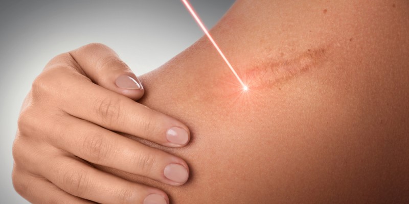 Công nghệ laser có thể loại bỏ sẹo lồi trên da một cách an toàn và hiệu quả