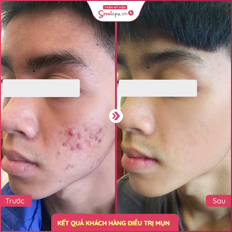 Công nghệ trị mụn hiệu quả vượt trội