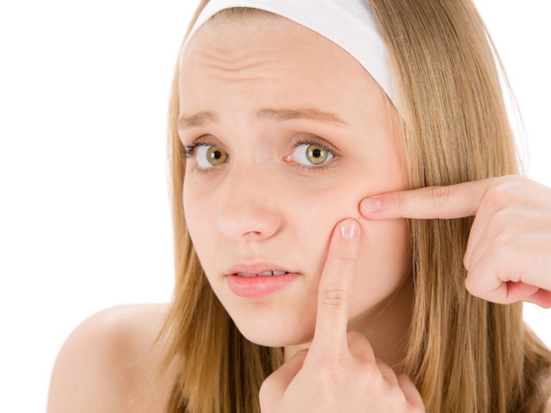 Không nên nặn mụn bởi sẽ làm tình trạng thêm nặng và hình thành vết thâm khó điều trị