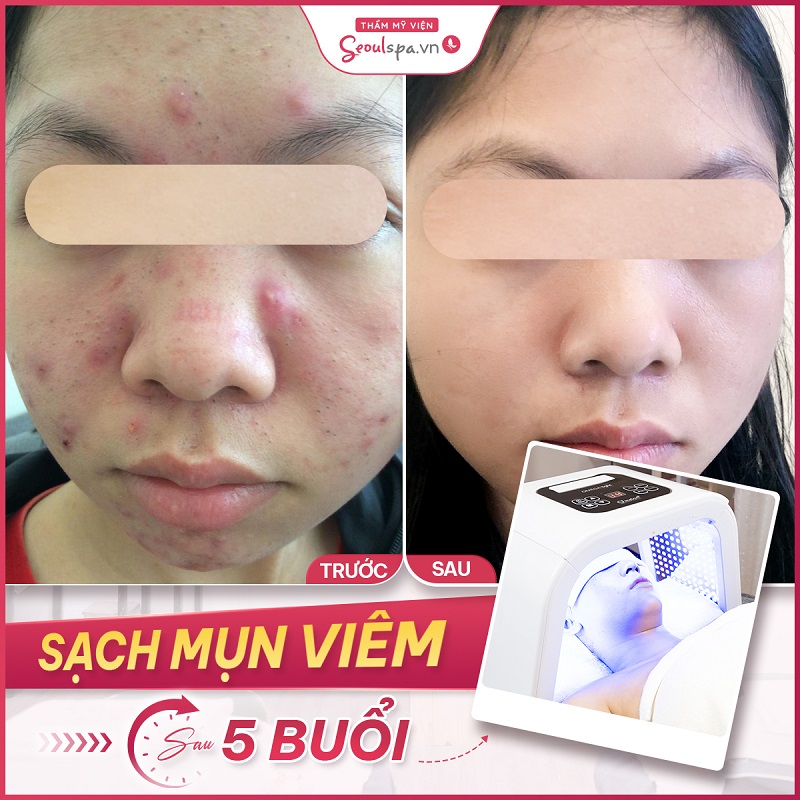 Top 20+ Tế Bào Gốc Dành Cho Da Nhạy Cảm Trị Mụn Laser Tế Bào Gốc Tơ Tằm - Trị Mụn Cho Làn Da Nhạy Cảm 28 Trị Mụn Tận Gốc Sau Liệu Trình