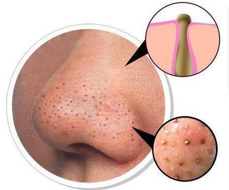 Top 20+ Tác Dụng Của Mật Ong Với Da Mặt Bị Mụn Top 8 cách trị thâm mụn bằng mật ong tại nhà hiệu quả nhất 38 Thời gian điều trị mụn phụ thuộc vào nhiều yếu tố như loại mụn, cơ địa,...