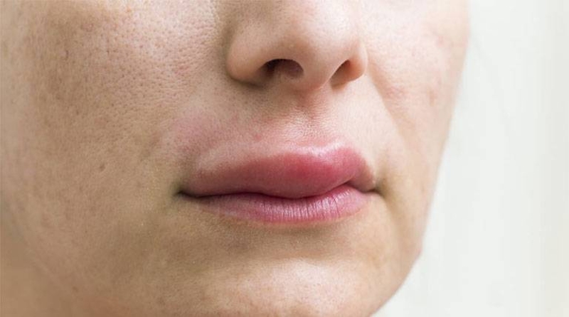 Top 20+ Chân Tự Nhiên Bị Sưng Phù Đau Nhức Môi tự nhiên bị sưng có sao không? Cách khắc phục thế nào? 47 Dị ứng môi trường có thể khiến môi tự nhiên bị sưng và có thể làm xuất hiện các tình trạng nghiêm trọng hơn