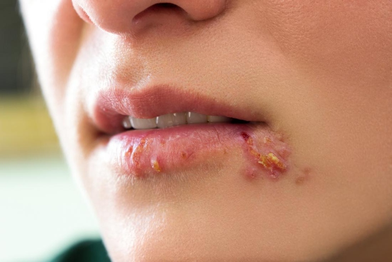 Top 20+ Chân Tự Nhiên Bị Sưng Phù Đau Nhức Môi tự nhiên bị sưng có sao không? Cách khắc phục thế nào? 53 Bệnh Herpes miệng không chỉ khiến môi tự nhiên bị sưng mà còn xuất hiện các đám mụn nước ở vị trí xung quanh