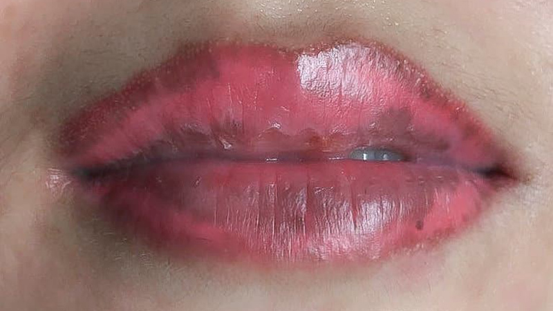 Top 20+ Chân Tự Nhiên Bị Sưng Phù Đau Nhức Môi tự nhiên bị sưng có sao không? Cách khắc phục thế nào? 58 Phun môi hỏng có thể khiến môi bị sưng, loang lổ, không đều màu và có thể dẫn đến viêm nhiễm