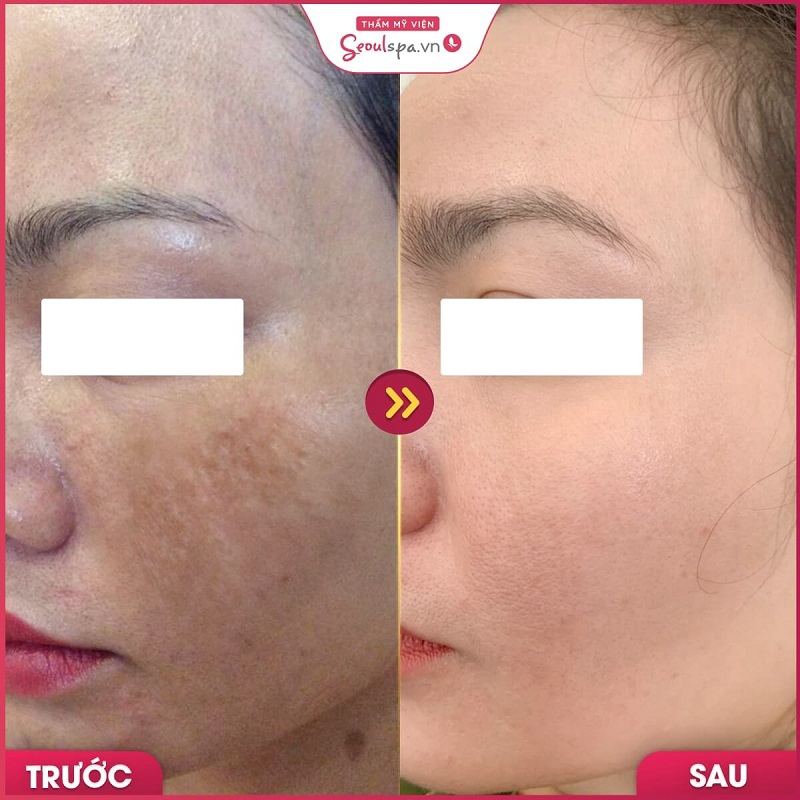 Công nghệ trị nám da chuyên sâu tại Thẩm mỹ viện Seoul Spa Nha Trang