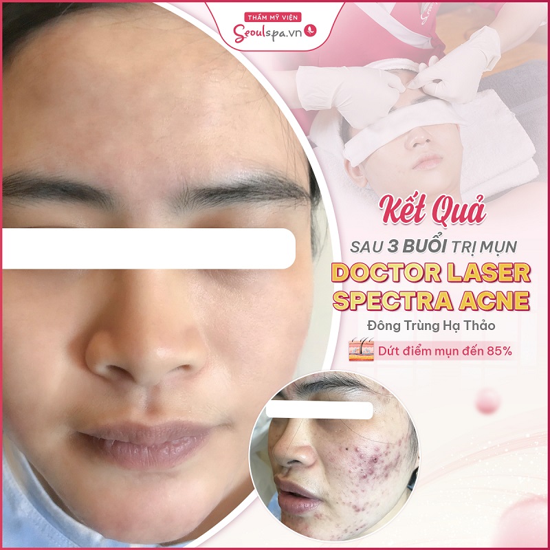 Top 20+ Khoa Thẩm Mỹ Bệnh Viện Da Liễu Quy Nhơn Top 6 địa chỉ Thẩm mỹ viện uy tín ở Quy Nhơn - Seoul Spa 52 Điều trị mụn là dịch vụ được rất nhiều khách hàng sử dụng tại SeoulSpa.Vn