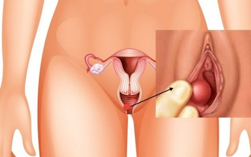 Top 20+ Vùng Kín Bị Sưng Đỏ Và Rát Vùng kín bị sưng một bên do dâu? Có nguy hiểm không? 23 Vệ sinh kém có thể gây sưng âm đạo
