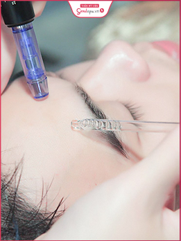 dịch vụ trị sẹo rỗ