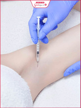 dịch vụ Trị hôi nách