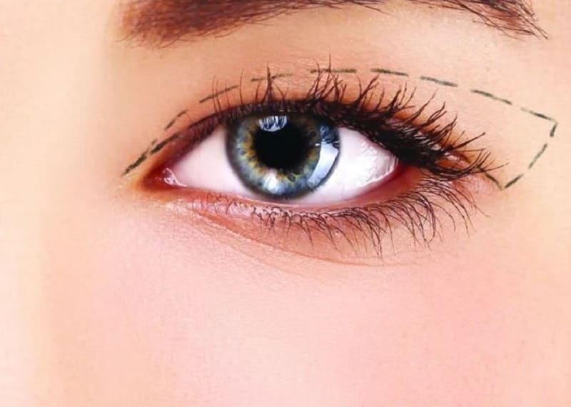 Hãy nhớ tuân thủ những chỉ dẫn của bác sĩ sau khi cắt mí để vết thương mau lành