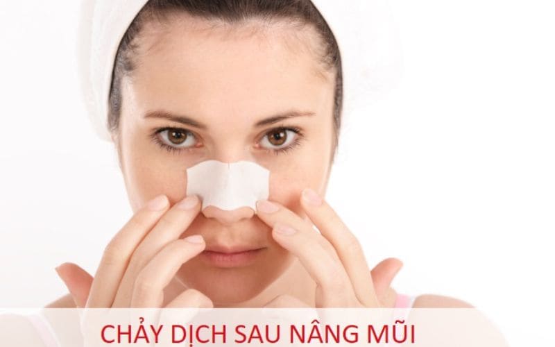 Sau nâng mũi, ăn mì tôm sẽ khiến dịch mũi chảy ra