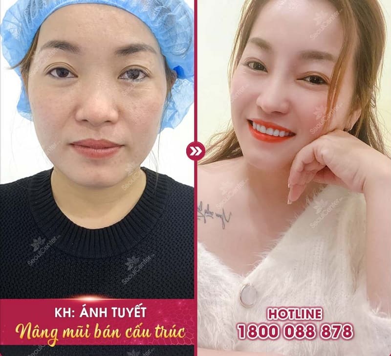 Nâng mũi Hàn Quốc giá bao nhiêu?