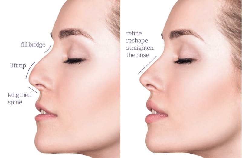 Ngoài cải thiện dáng mũi, nên quan tâm đến các khuyết điểm như mũi gồ, lệch…