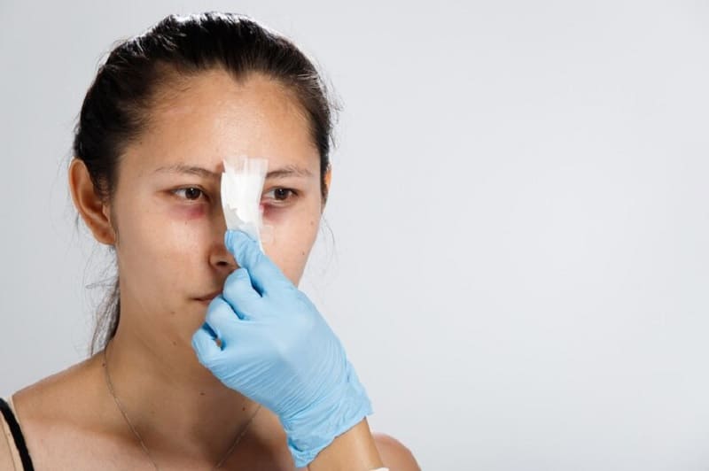 Quá trình thực hiện nhẹ nhàng, mũi nhanh lành, không để lại sẹo