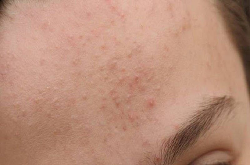 Top 20+ Học Trò Hư Đòi Tắm Chung Với Nữ Gia Sư Peel da trị thâm mụn có thật sự hiệu quả? Những lưu ý cần nhớ 35 Lột giúp đẩy nhân mụn lên, hỗ trợ quá trình điều trị mụn nhẹ nhàng hơn