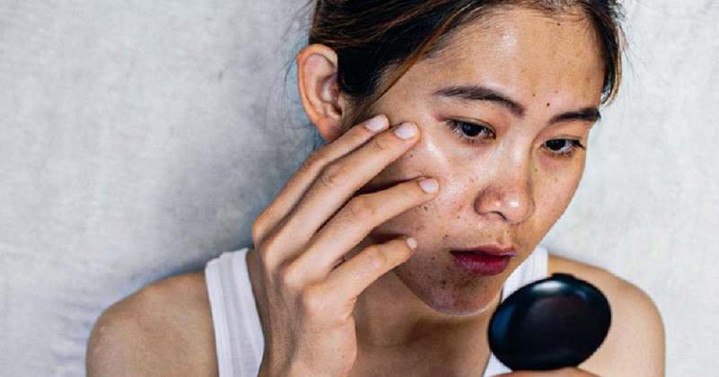 Top 20+ Học Trò Hư Đòi Tắm Chung Với Nữ Gia Sư Peel da trị thâm mụn có thật sự hiệu quả? Những lưu ý cần nhớ 31 Nếu không thoa kem chống nắng sau khi lột da rất dễ khiến da sạm đen và lão hóa nhanh hơn