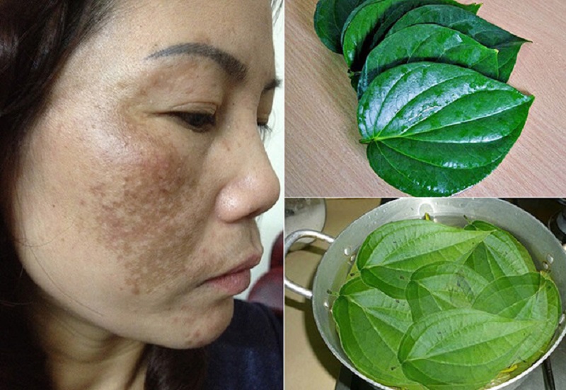Top 20+ Cách Chữa Nám Da Mặt Bằng Lá Trầu Không Top 8 cách trị nám bằng lá trầu không tại nhà hiệu quả 33 Lá trầu không có thành phần tốt cho da và hỗ trợ trị nám an toàn
