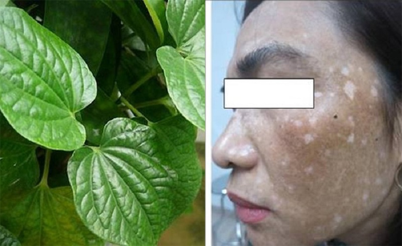 Top 20+ Cách Chữa Nám Da Mặt Bằng Lá Trầu Không Top 8 cách trị nám bằng lá trầu không tại nhà hiệu quả 34 Có nhiều cách trị nám bằng lá trầu không mà bạn có thể lựa chọn