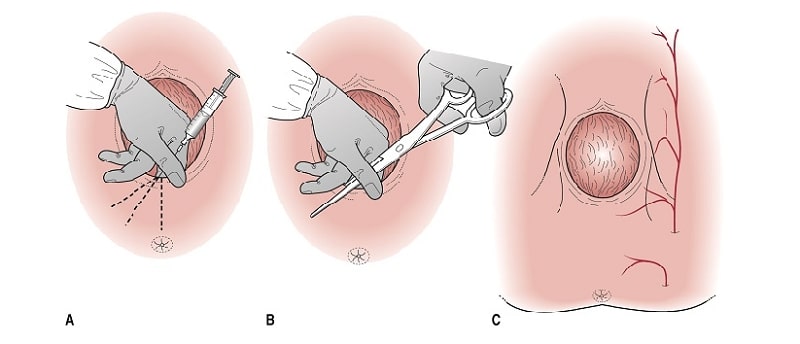 Cắt tầng sinh môn giúp sinh nở tốt hơn