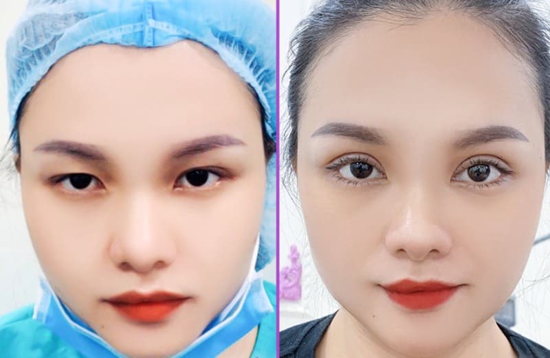 Vẻ đẹp trong veo của cô gái khi áp dụng kỹ thuật cắt mí mini deep