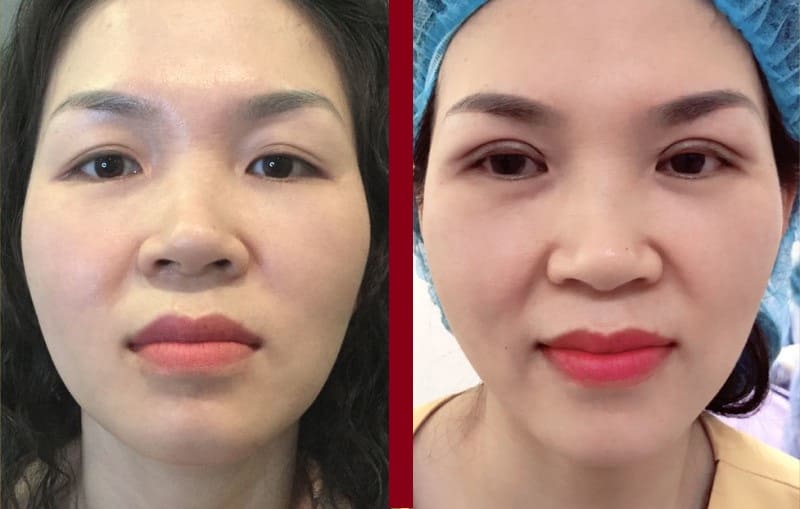 Cắt mí mắt mini deep giúp đôi mắt trẻ trung hơn