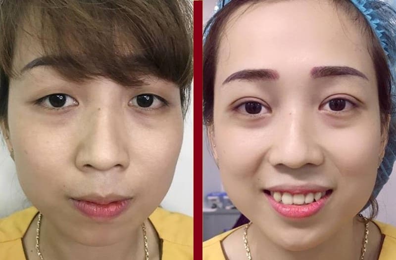 Đồng thời, đôi mắt cũng trở nên to tròn, cân đối và thu hút hơn