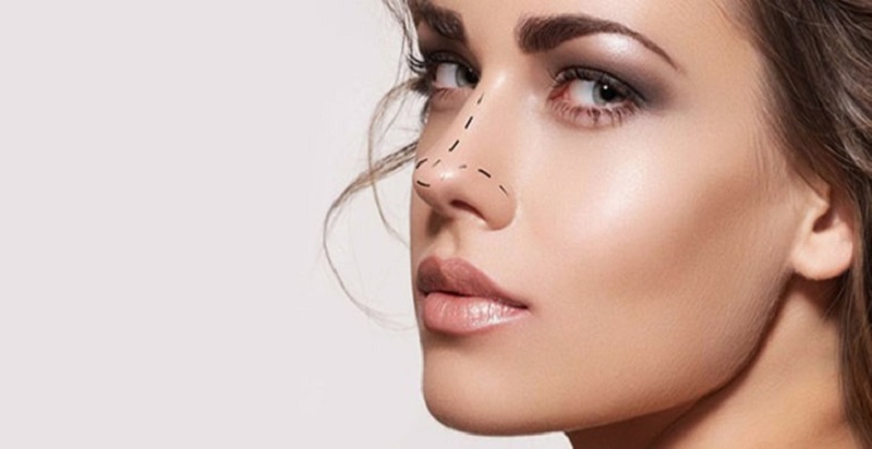Độ bền của nâng mũi tùy thuộc vào nhiều yếu tố chủ quan lẫn khách quan