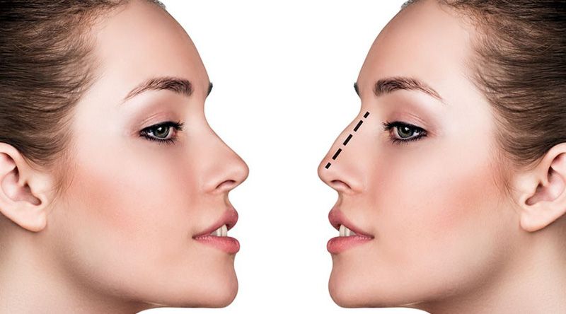 Nắm tất tần tật thông tin về nâng mũi để tự tin đưa ra quyết định cho riêng mình