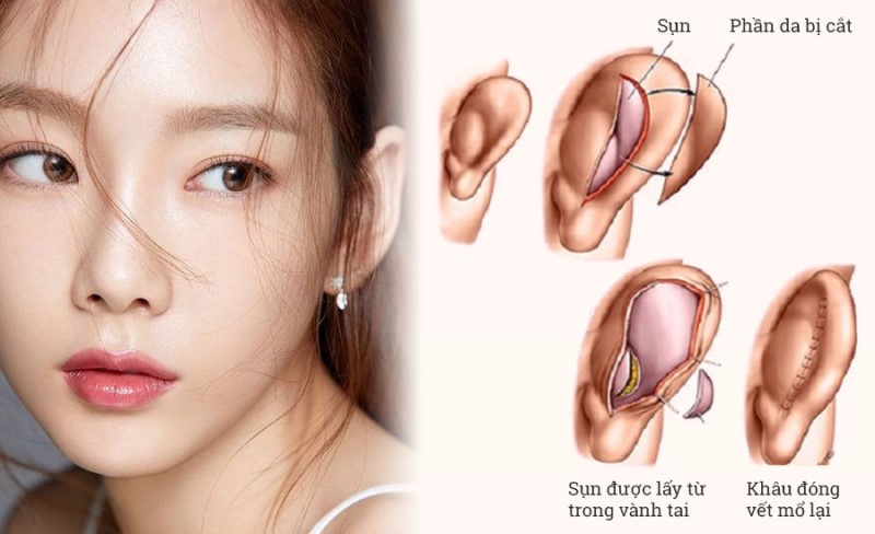 Nâng mũi bằng sụn tai là giải pháp thẩm mỹ hiện đại, an toàn nhất hiện nay