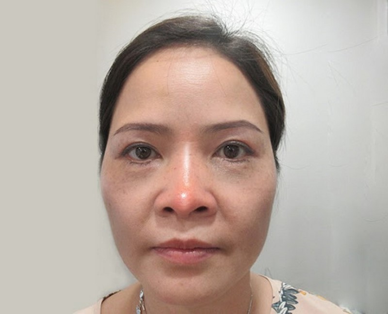 Sau khi thẩm mỹ, đầu mũi có xu hướng sưng to hơn trong thời gian đầu