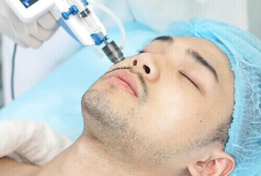 Triệt râu vĩnh viễn cho nam giới giá bao nhiêu tiền? Giá 5/2024