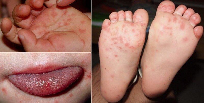 Top 20+ Nguyên Nhân Bị Mụn Cóc Ở Bàn Chân Các loại mụn ở chân và cách khắc phục hiệu quả 31 Nổi mụn ở bàn chân có thể là dấu hiệu của bệnh tay chân miệng