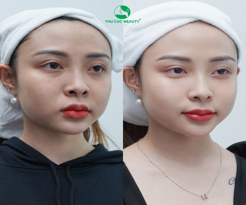 Căng chỉ da mặt tại bệnh viện Thu Cúc Hà Nội