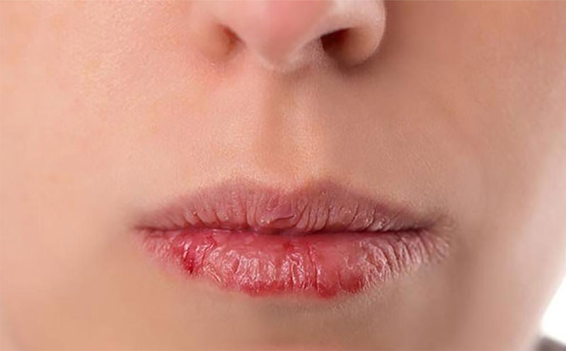 Vùng da môi khô nứt nẻ là tình trạng da thiếu độ ẩm bong tróc, nứt nẻ