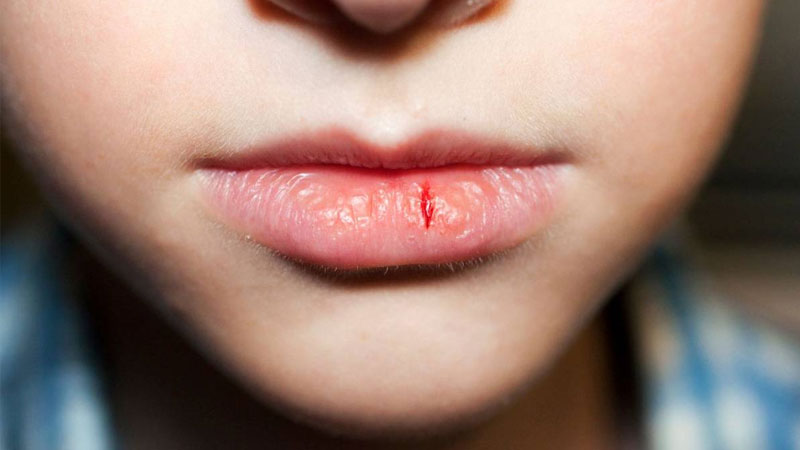 Bị khô môi do bệnh lý gây ra
