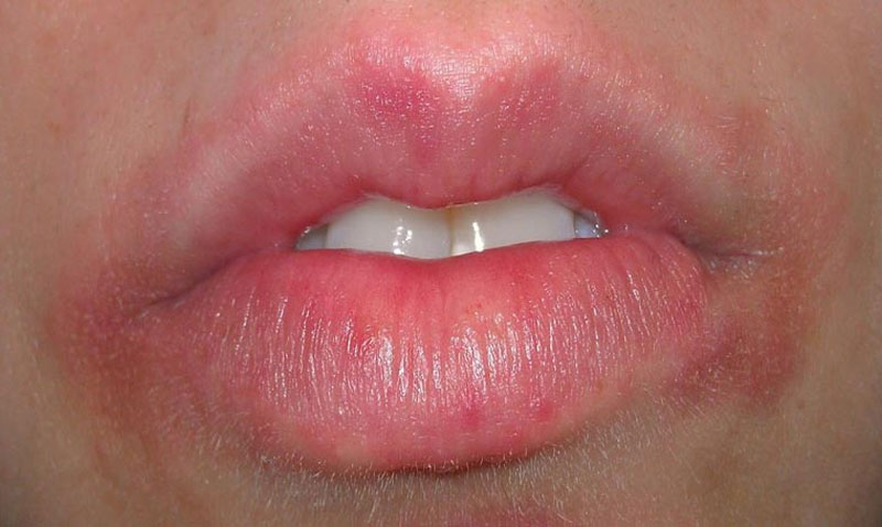 Bị khô môi do dị ứng với flo