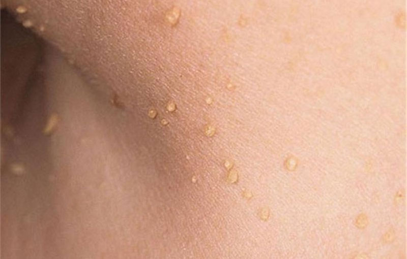 Mụn thịt không thể lây từ người này sang người khác