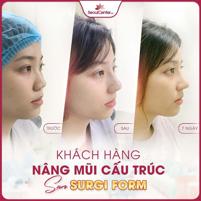 SeoulCenter.Vn có nhiều dịch vụ nâng mũi cao cấp, đảm bảo an toàn và hiệu quả vượt trội