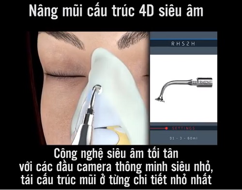 Nâng mũi cấu trúc 4D siêu âm có sử dụng công nghệ siêu âm hiện đại