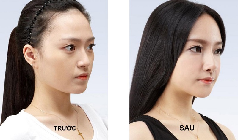 Cấu trúc mũi được tái lập hoàn toàn sau khi nâng mũi cấu trúc