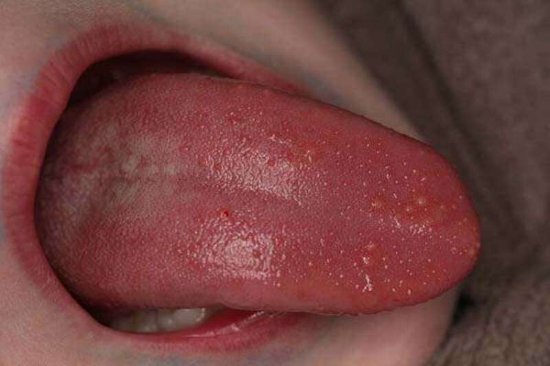 Nổi mụn ở lưỡi là dấu hiệu của bệnh u nhú tiền đình Papillomatosis