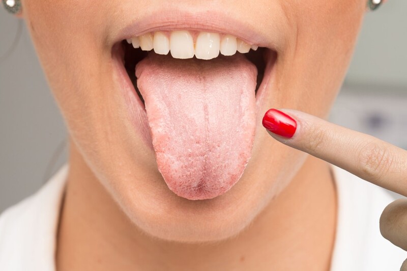 Viêm lưỡi là một bệnh lý nghiêm trọng cần điều trị sớm và đúng cách